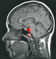 hypothalamus picture