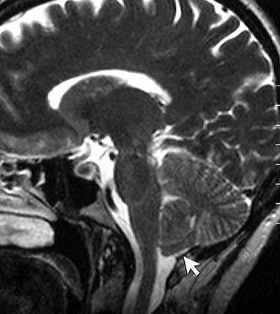 MRI - Chiari malformation
