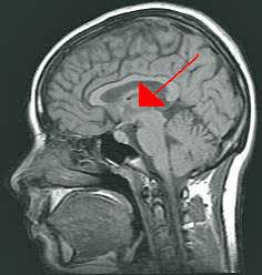 Thalamus in the brain