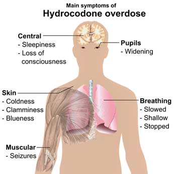 Hydrocodone overdose chart