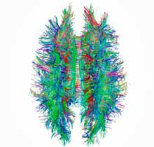 Is white matter damage in the primitive areas of the brain causing ME/CFS? More studies are needed...