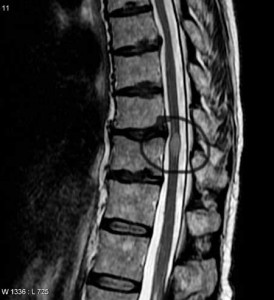 A spinal cord lesion