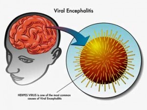 viral-encephalitis