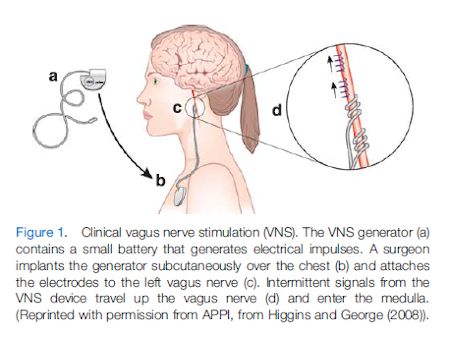 Vagus  Nerve Stimulation