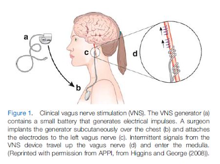 Using TENS Machine for Vagus Nerve Stimulation