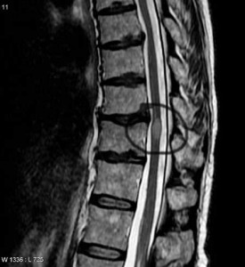 The spinal cord lesion