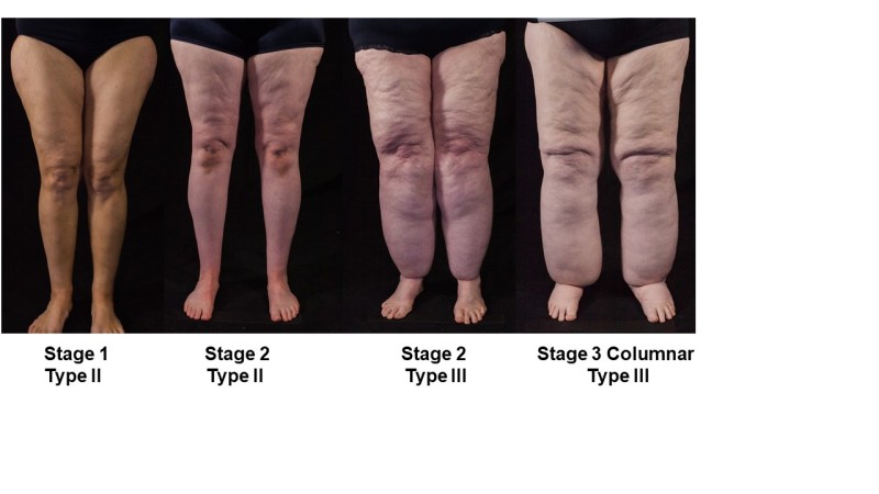 Should There Be An Increased Focus On Lipedema The Lymphatic System