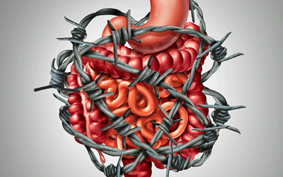 irritable bowel syndrome