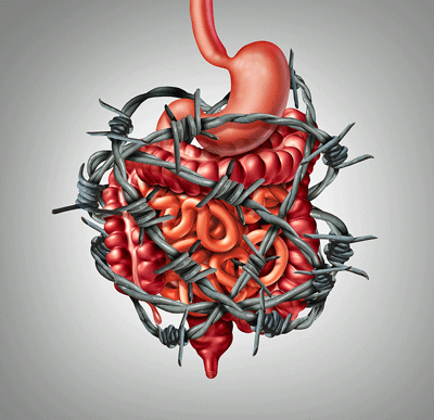 irritable bowel syndrome