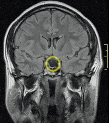 Empty Sella Syndrome